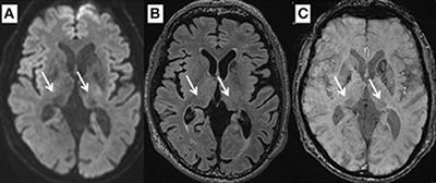 Low Pulvinar Intensity in Susceptibility-Weighted Imaging May Suggest Cognitive Worsening After Deep Brain Stimulation Therapy in Patients With Parkinson's Disease